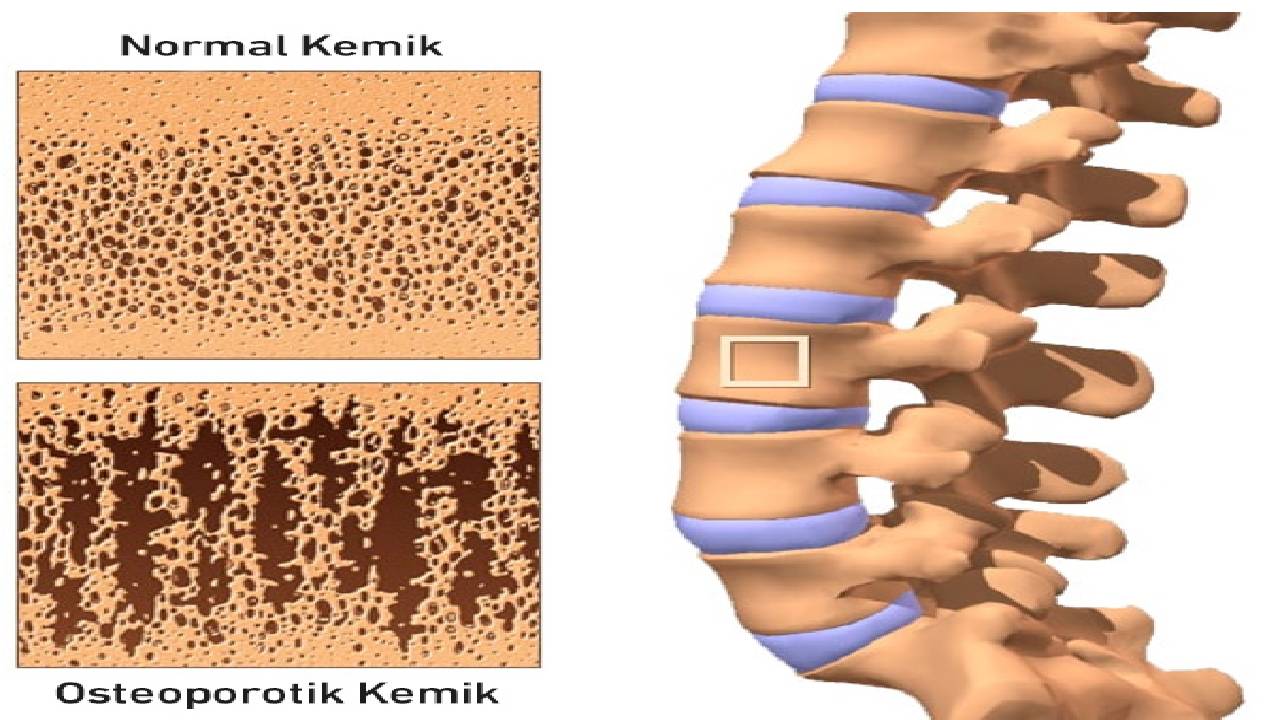 Kemik erimesinde sessiz tehlike: Kırık riski yüzde 50'yi aşıyor!